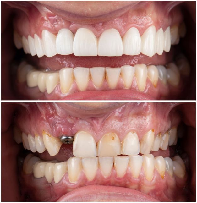 implant 1