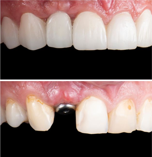 implant 2