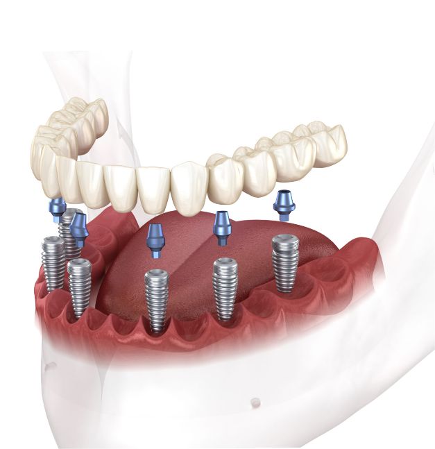 implant 3